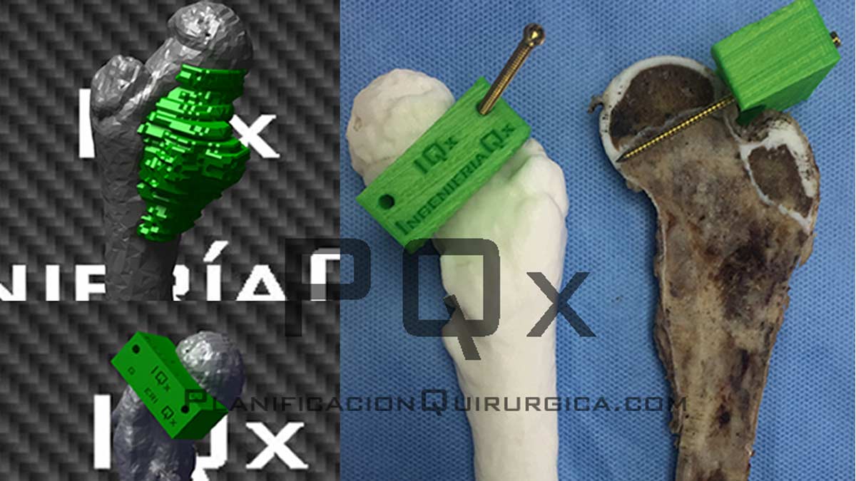 Customized Medical Instrumentation for Tumor Surgical Planning with the VEGA PQX Navigator