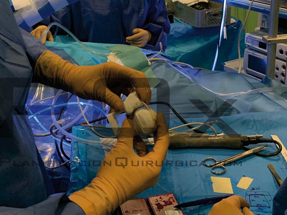 Superior capsular reconstruction surgery with the VEGA PQX Navigator
